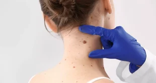 How is the Mole Removal Procedure Performed and What Methods are Used?