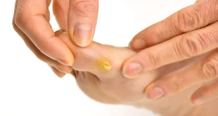 Why Do Corns Occur, and How to Get Rid of Corns on Hands and Feet?